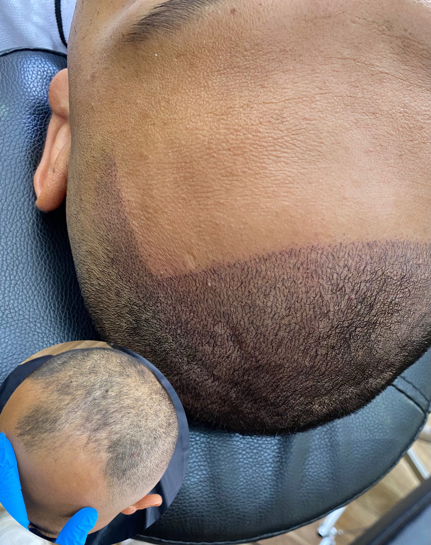 Micropigmentación capilar